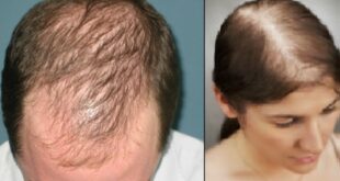 İlk aşamada saç bir ay boyunca yaklaşık bir cm uzar. Bu 1 ay saç döngüsünün en uzun aşamasıdır. Bu aydan sonra saç, üç hafta dinlenmeye çekilir. Üçüncü haftadan sonra ise, son evre olan dökülme evresi başlar. Bu evrede saçınızı taramanız, yıkamanız ile beraber o saçlar düşecektir. İşte bu döngü olduğu için, günlük ortalama 100 tel saç dökülmesi normaldir. Bunda korkacak bir şey yok. Ama bazen, bu durum sizler için tehlikeli bir hal alabilir. Saç döngüsü adını verdiğimiz süreç dışında, bütün bir yıl elinizi saçınıza attığınızda elinize çok sayıda saç teli geliyorsa tehlike çanları sizin için çalmaya başlamış demektir. Bu, bir sağlık sorunu olan saç dökülmesi işaretidir.