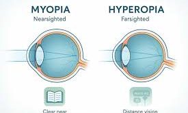 Myopia, one of the most common eye disorders, is defined as the problem of near vision. People with myopia have blurred vision of distant objects. The main factor that causes this situation is that the image is not fully focused on the retina. In this case, distant objects cannot be seen clearly.