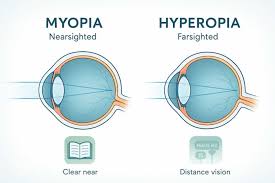 Myopia, one of the most common eye disorders, is defined as the problem of near vision. People with myopia have blurred vision of distant objects. The main factor that causes this situation is that the image is not fully focused on the retina. In this case, distant objects cannot be seen clearly.