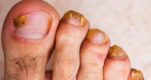 Tırnak mantarı yaygın ancak ihmal edilmemesi gereken bir sağlık sorunudur. Erken teşhis ve doğru tedavi ile kontrol altına alınabilir. Tırnaklarda renk, şekil veya yapı değişikliği fark edildiğinde bir sağlık uzmanına başvurmak, enfeksiyonun ilerlemesini önlemek açısından büyük önem taşır.