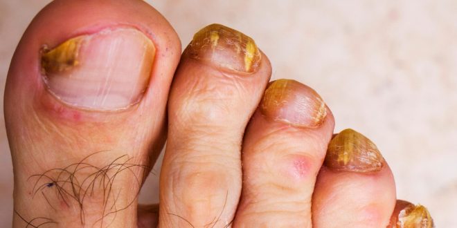 Tırnak mantarı yaygın ancak ihmal edilmemesi gereken bir sağlık sorunudur. Erken teşhis ve doğru tedavi ile kontrol altına alınabilir. Tırnaklarda renk, şekil veya yapı değişikliği fark edildiğinde bir sağlık uzmanına başvurmak, enfeksiyonun ilerlemesini önlemek açısından büyük önem taşır.